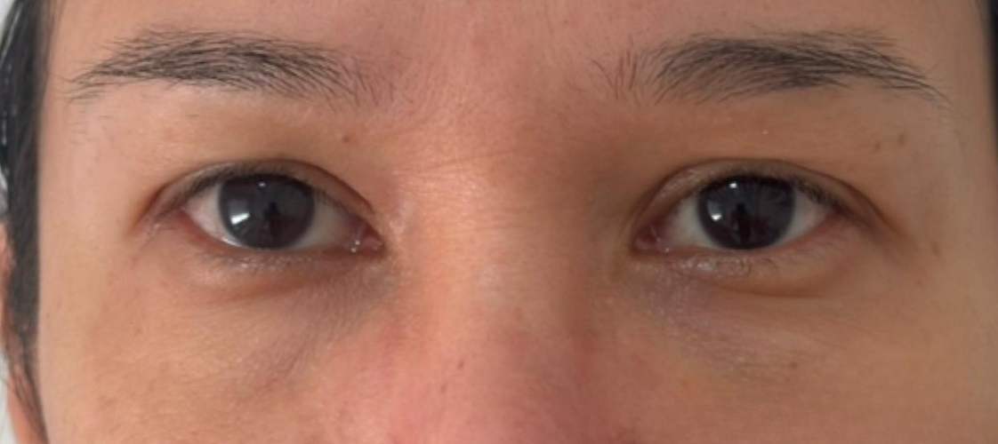Depois da blefaroplastia
