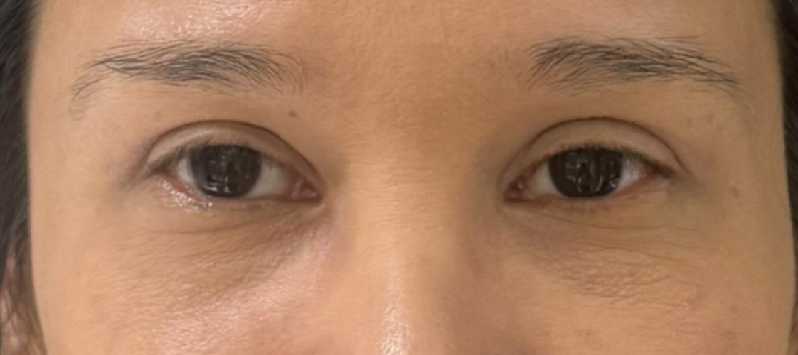 Antes da blefaroplastia